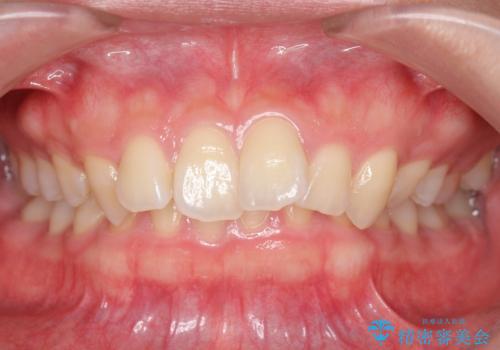 深いかみ合わせ 出っ歯の治療 インビザラインでの症例 治療前