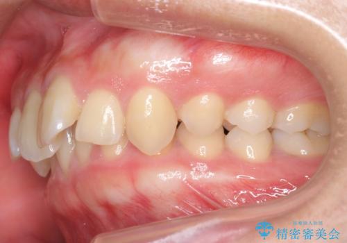 深いかみ合わせ 出っ歯の治療 インビザラインでの治療前