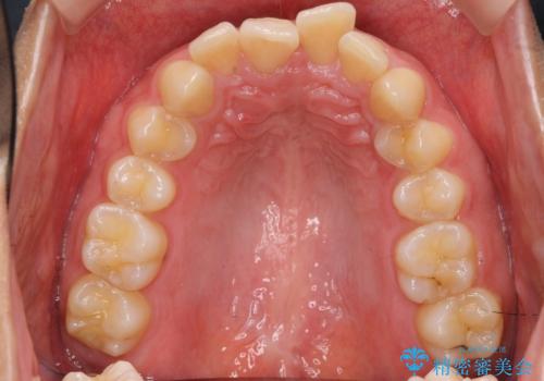 深いかみ合わせ 出っ歯の治療 インビザラインでの治療前