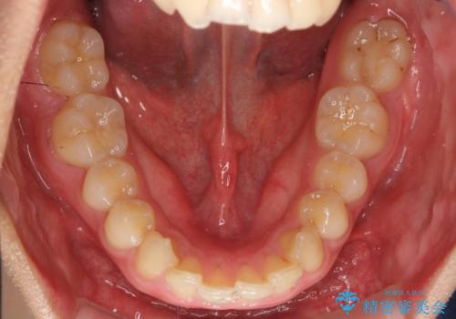 深いかみ合わせ 出っ歯の治療 インビザラインでの治療前