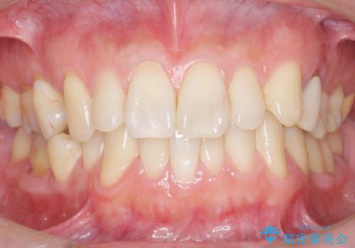 内側に生えている歯をなんとかしたい 矯正は嫌 30代男性の治療後