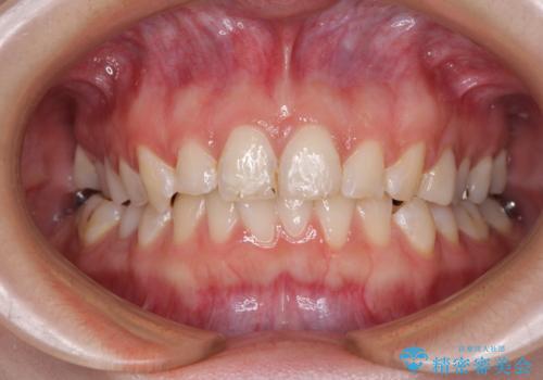 インビザライン単独では困難 補助装置を併用した矯正治療の治療中