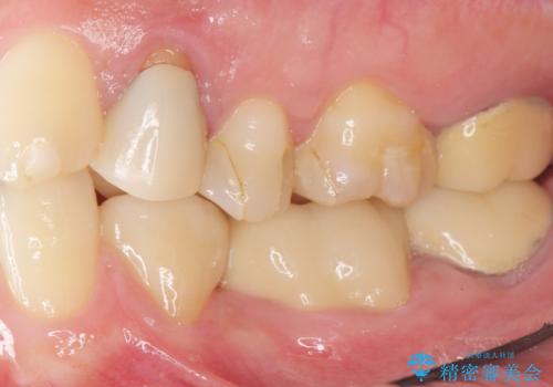 内側に生えている歯をなんとかしたい 矯正は嫌 30代男性の治療後