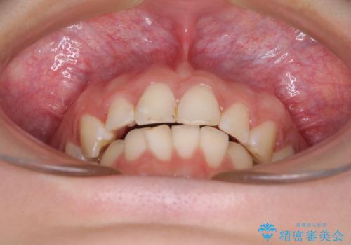 インビザライン単独では困難 補助装置を併用した矯正治療の治療中