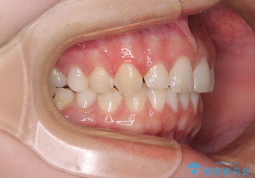 インビザライン単独では困難 補助装置を併用した矯正治療の治療中