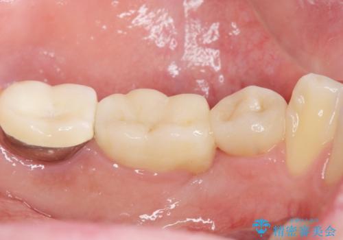 内側に生えている歯をなんとかしたい 矯正は嫌 30代男性の治療後