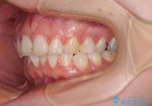 インビザライン単独では困難 補助装置を併用した矯正治療の治療中