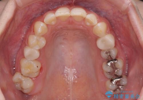 インビザライン単独では困難 補助装置を併用した矯正治療の治療中