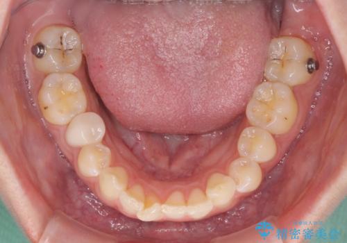 インビザライン単独では困難 補助装置を併用した矯正治療の治療中