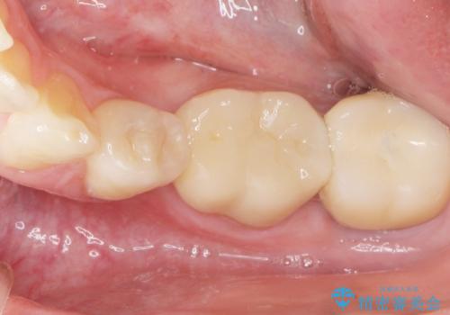 内側に生えている歯をなんとかしたい 矯正は嫌 30代男性の治療後