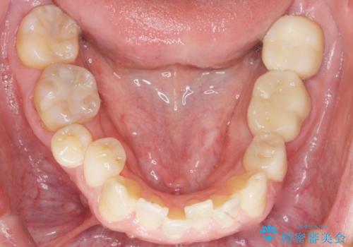 内側に生えている歯をなんとかしたい　矯正は嫌　30代男性の治療後