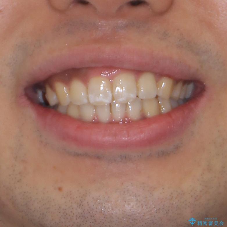 インビザラインによる矯正治療と、折れてしまった歯のインプラント補綴治療の治療後（顔貌）