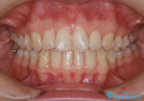 見た目だけじゃない:マウスピースでも短期間で噛み合わせと口元を改善の治療中