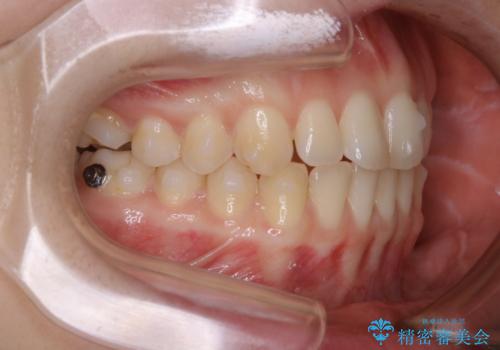 見た目だけじゃない:マウスピースでも短期間で噛み合わせと口元を改善の治療中