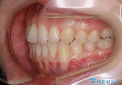 見た目だけじゃない:マウスピースでも短期間で噛み合わせと口元を改善の治療中