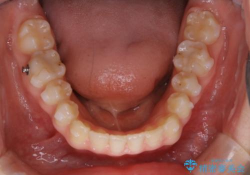見た目だけじゃない:マウスピースでも短期間で噛み合わせと口元を改善の治療中