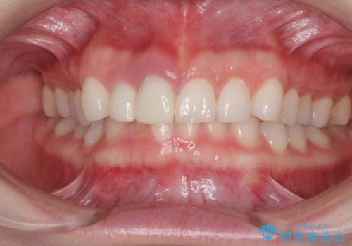 一度諦めた矯正にチャレンジしたい インビザラインとセラミック治療の治療前