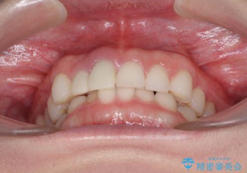 一度諦めた矯正にチャレンジしたい インビザラインとセラミック治療の治療前