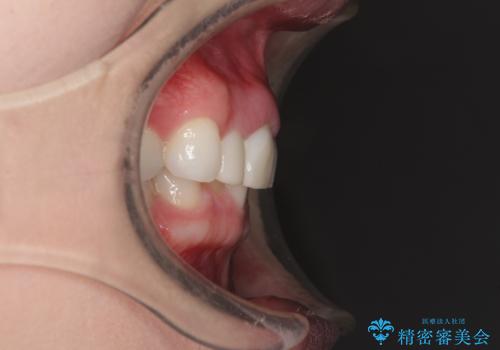 一度諦めた矯正にチャレンジしたい インビザラインとセラミック治療の治療前