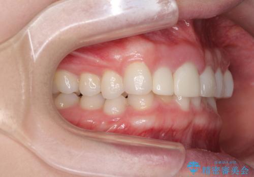 一度諦めた矯正にチャレンジしたい インビザラインとセラミック治療の治療前