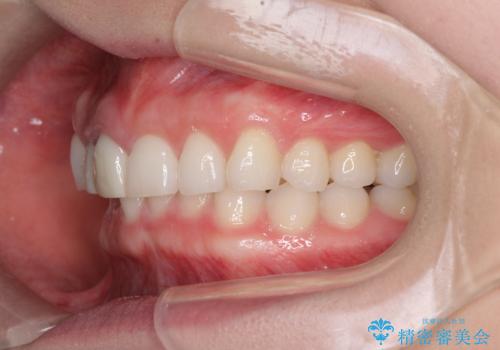 一度諦めた矯正にチャレンジしたい インビザラインとセラミック治療の治療前