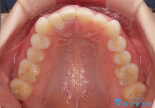 一度諦めた矯正にチャレンジしたい インビザラインとセラミック治療の治療前