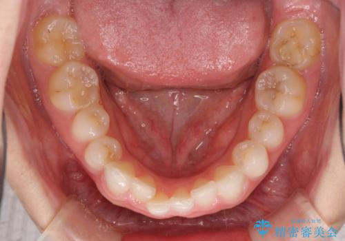 一度諦めた矯正にチャレンジしたい インビザラインとセラミック治療の治療前