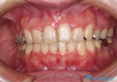 目立つ銀歯を白くしたい 奥歯のセラミック治療の症例 治療前