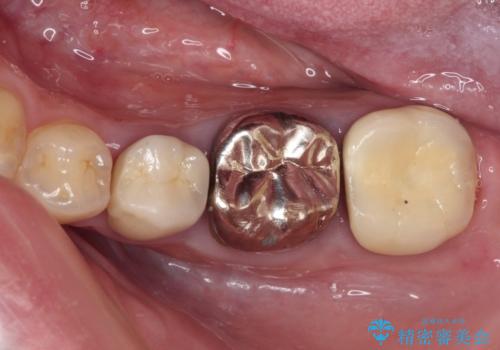 目立つ銀歯を白くしたい 奥歯のセラミック治療の治療前