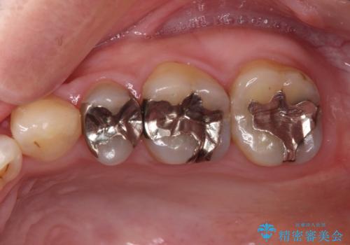 目立つ銀歯を白くしたい 奥歯のセラミック治療の治療前