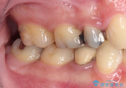 目立つ銀歯を白くしたい 奥歯のセラミック治療の治療前