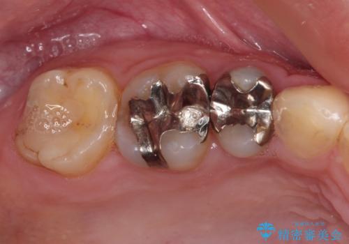 目立つ銀歯を白くしたい 奥歯のセラミック治療の治療前
