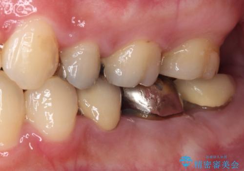 目立つ銀歯を白くしたい 奥歯のセラミック治療の治療前