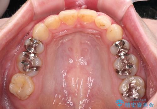 目立つ銀歯を白くしたい 奥歯のセラミック治療の治療前