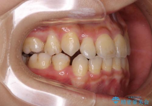 インビザラインの矯正中のクリーニングの治療前