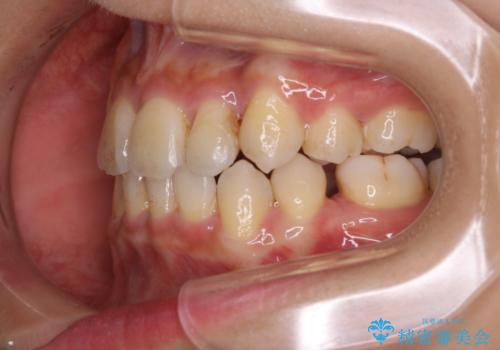 インビザラインの矯正中のクリーニングの治療前