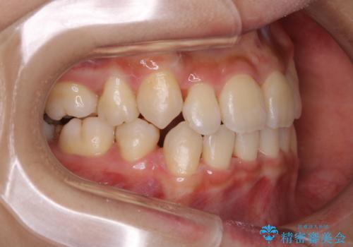 インビザラインの矯正中のクリーニングの治療後