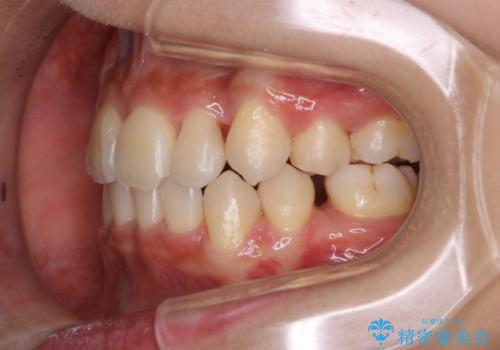 インビザラインの矯正中のクリーニングの治療後