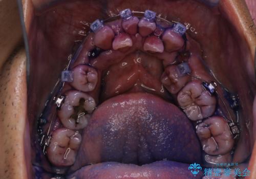 表のワイヤー装置で矯正中にPMTCで綺麗にお掃除の治療前