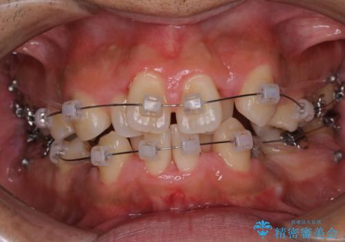 表のワイヤー装置で矯正中にPMTCで綺麗にお掃除の治療後