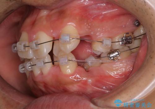 表のワイヤー装置で矯正中にPMTCで綺麗にお掃除の治療後