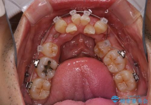 表のワイヤー装置で矯正中にPMTCで綺麗にお掃除の治療後