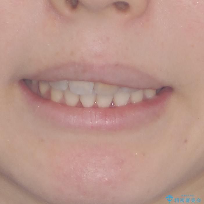 内側にある歯が邪魔　重なった前歯の歯列矯正の治療後（顔貌）