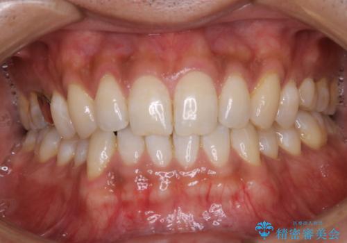 結婚式前に歯のクリーニンングで清潔感を!の治療前