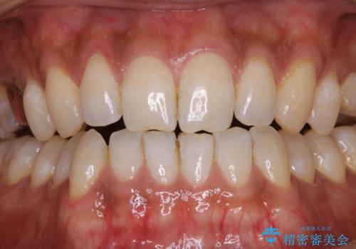 結婚式前に歯のクリーニンングで清潔感を!の治療前