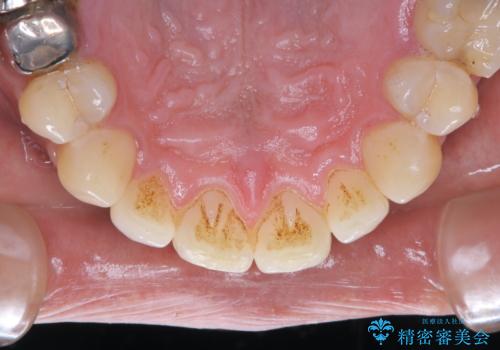 結婚式前に歯のクリーニンングで清潔感を!の治療前