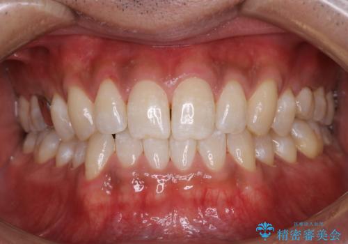 結婚式前に歯のクリーニンングで清潔感を!の治療後
