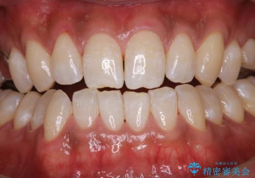 結婚式前に歯のクリーニンングで清潔感を!の治療後