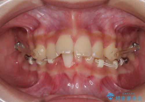 下の前歯が隠れてしまうほど深い咬み合わせ 高校生のインビザライン矯正治療の治療中