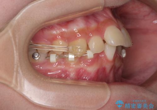 下の前歯が隠れてしまうほど深い咬み合わせ 高校生のインビザライン矯正治療の治療中
